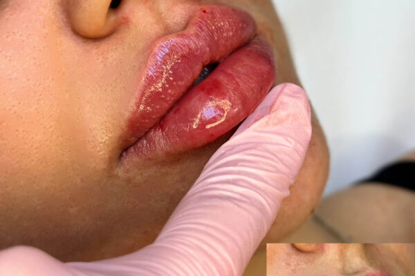 Volumizare Buze cu Acid Hialuronic – Tot Ce Trebuie Să Știi Înainte de Tratament