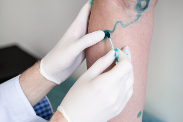 Boala Arterială Periferică – Simptome, Diagnostic și Tratament | Clinica VisMed