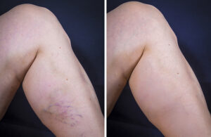 Scleroterapie vene varicoase – Clinica VisMed Slobozia, Dr. Raluca Popa